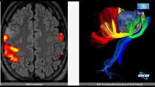 Diagnosi dei tumori cerebrali Intervista al Dott Christian Brogna neurochirurgo [upl. by Mainis]