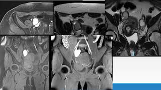 Diagnóstico de Endometriosis por RMN con equipos 3T Parte 2 [upl. by Korman]