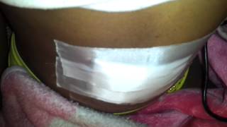 My journey through my umbilical hernia repair [upl. by Eerrehc465]