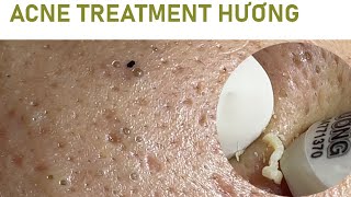 Acne Treatment Huong Da Nang  2024 blackheads 702 [upl. by Tallou]