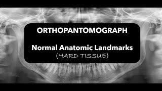 Hard tissue landmarks in OPG [upl. by Eibloc]