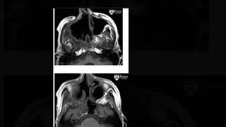 Perineural tumor spread [upl. by Roye394]