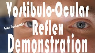 Caloric Testing COWS VestibuloOcular Reflex Hack  It Works [upl. by Ahsinar44]