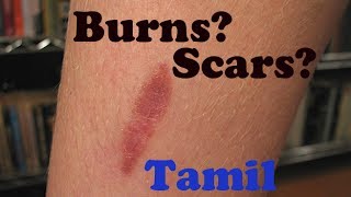 How to treat Burns and Scars  Tamil [upl. by Ennad]