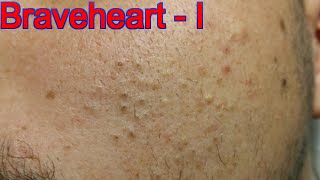 Extraction for Teenage Acne  Part 1 of 3 [upl. by Aseek]