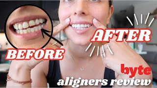 BYTE ALIGNERS REVIEW  progress  byte aligners before amp after [upl. by Maharva]