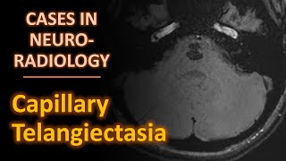 Cases in Neuroradiology Capillary Telangiectasia [upl. by Rosenquist]