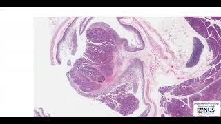 Duodenum and Pancreas Ampullary carcinoma  Talking slide [upl. by Barn]