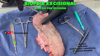 Biopsia excisional [upl. by Hapte]