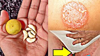 दाद खाज खुजली की देखते देखते 1 ही बार में छुट्टी कर देगा  skin infection formula2019 [upl. by Linkoski]