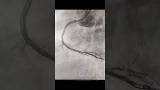 Angioplasty of severe fibrocalcific RCA [upl. by Oterol]