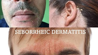 Seborrheic dermatitis  treatment health [upl. by Melleta]