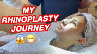 RHINOPLASTY JOURNEY [upl. by Sirahc]