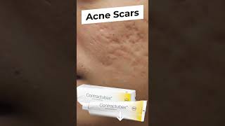 Acne scars treatment contractubex gel for acne scars Shorts youtubeshorts [upl. by Afatsom]