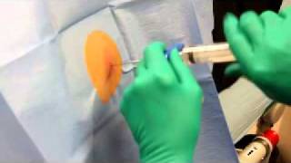 Bone marrow extraction [upl. by Fonville]