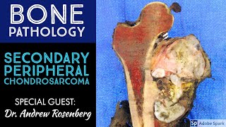 Secondary Peripheral Chondrosarcoma from OsteochondromaExostosis Bone Pathology with Dr Rosenberg [upl. by Ennaid]