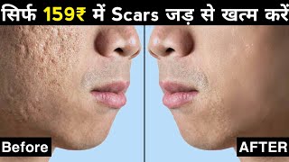 Acne Scars के 3 Treatment  How To Remove Pimples Holes Scars Hindi [upl. by Nivram]