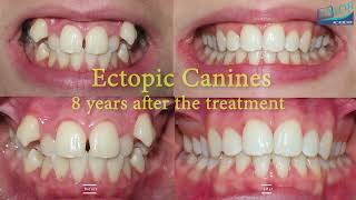 Trailer of Ectopic Canines in 4K [upl. by Neelhtak]