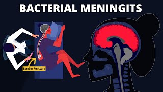 Bacterial Meningitis  Symptoms Diagnosis Treatments amp Pathology [upl. by Sara]