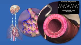 Pathology of Pulmonary Hypertension and Right Heart Failure [upl. by Mcintosh926]