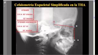 Odontologìa y mucho màs Cefalometrìa Simplificada de Steine [upl. by Keram381]