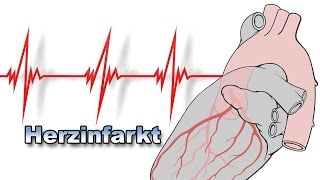 Herzinfarkt  Krankheiten des Herzens  Pflege Kanal [upl. by Yelhsa]