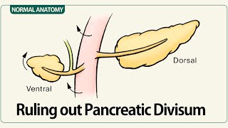 Ruling out Pancreatic Divisum [upl. by Babbette]