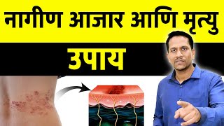 नागीण आजरा आणि मृत्यू Herpes zoster virus treatment  Dr Nagarekar [upl. by Eiramana]