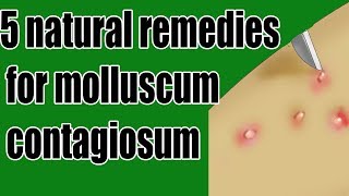 5 natural remedies for molluscum contagiosum  molluscum contagiosum Treatment [upl. by Eckhardt871]