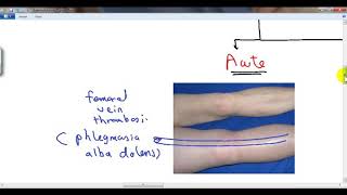 GENERAL PATHOLOGY 40  hyperaemia and oedema DR SAMEH GHAZY [upl. by Duky]