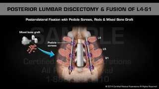 Posterior Lumbar Discectomy amp Fusion of L4S1 [upl. by Negriv116]