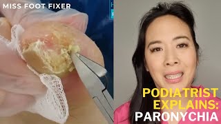 Emergency Nail Infection Treatment Quick Paronychia Relief While Traveling  Miss Foot Fixer [upl. by Judon]