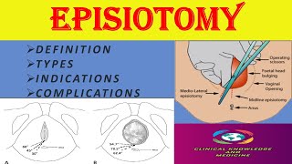 Episiotomy Definition Indications Types Complications [upl. by Leihcey400]