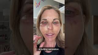 My Advanced Facelift Recovery Day by Day  Real Stories By Real Patients 2022 [upl. by Attayek]