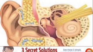 vagus nerve stimulation tinnitus [upl. by Aryamoy]