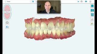 iTero ScanCase Review  Abfraction Recession Spacing Fractures Decay [upl. by Constantine]