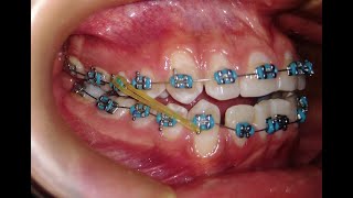 Elásticos Intermaxilares  Mira como ayudan en tu tratamiento con brackets☝ [upl. by Costa]