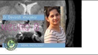 TMT Neuro Case 8 by Dr Devarati Khurjekar [upl. by Hgielrak]