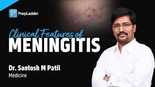 Clinical Features of Meningitis by Dr Santosh M Patil [upl. by Stout]