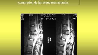 NeurorgsnetFractura aplastamiento traumatica L1 Pablo Hernandez [upl. by Onitnelav]