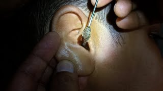 Fully blocked Ear Wax Removal [upl. by Elacim]