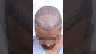 Failed Hairline Hair Transplant Correction [upl. by Iridis509]