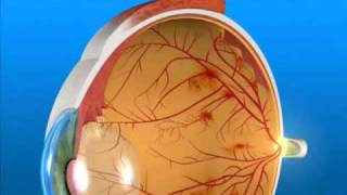 Understanding Proliferative Diabetic Retinopathy [upl. by Eihpos88]