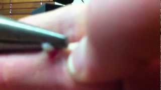 how to remove a wart [upl. by Hindu]