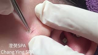 桃園中壢清粉刺 臉頰黑頭清除 Blackheads on face Removal！ [upl. by Cott]