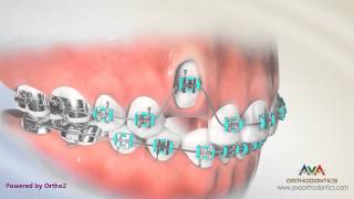 Orthodontic Treatment for Impacted Canine  Laser Exposure [upl. by Glassco]