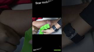 Scar mobilization with taping physio doctor kneepainrelief viralshorts trending treatment [upl. by Phelan]