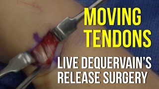 Moving Tendons In A Live Surgery  DeQuervain’s Release [upl. by Gage]