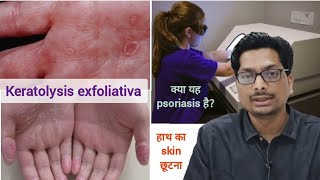 हाथ का skin छूटना  क्या यह psoriasis है Keratolysis exfoliativa  Peeling of hand skin psoriasis [upl. by Akehsyt]