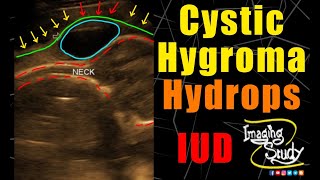 Hydrops fetalis with Fetal ascites pleural effusion pericardial effusion and Soft tissue edema [upl. by Akoyin]